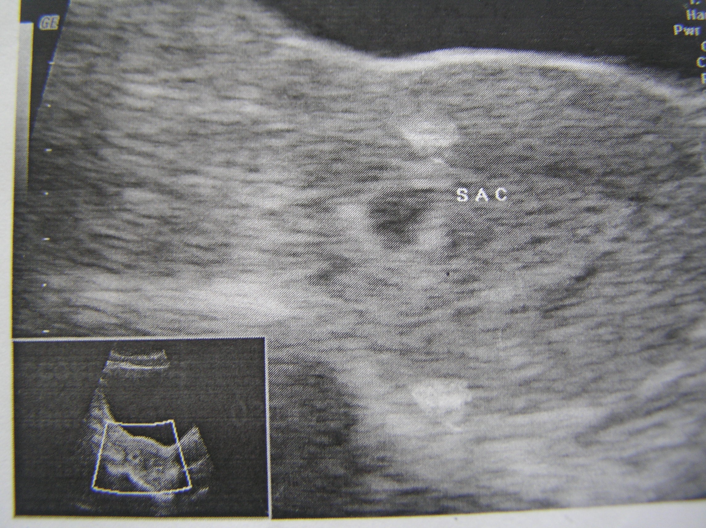 Week5 Scan of Pregnancy