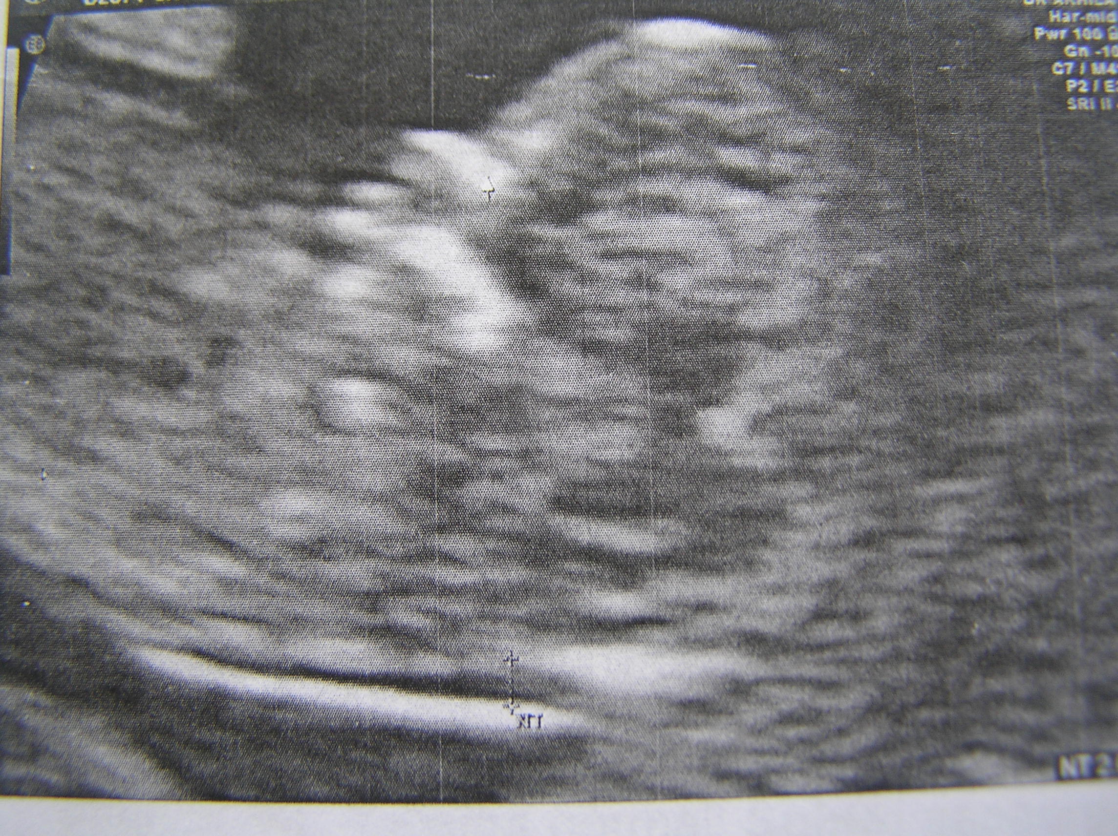 12 weeks day 1 ultrasound scan