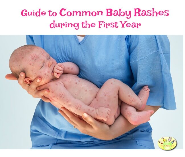 Guide to Common Skin Rashes in Babies