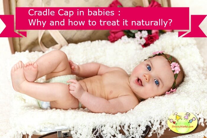cradle cap treatment