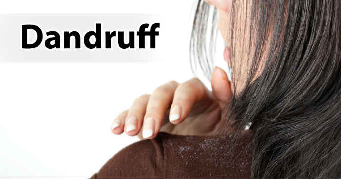 8 DIY Home Remedies to get rid of Dandruff