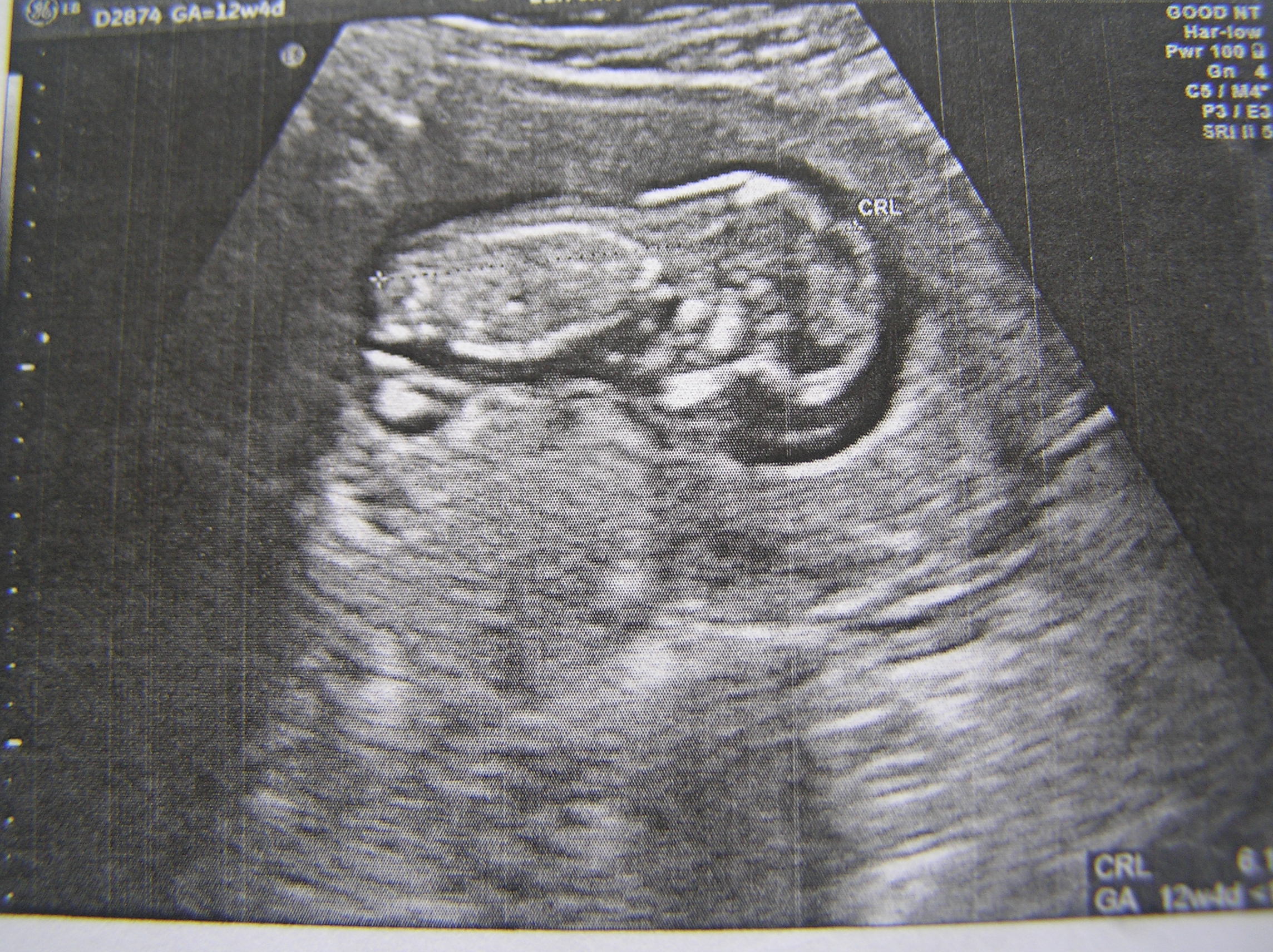 12 weeks day 1 ultrasound scan