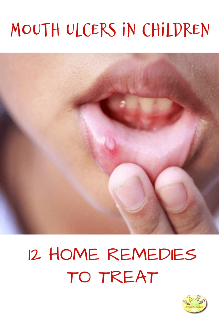 Home remedies to treat mouth ulcers in kids